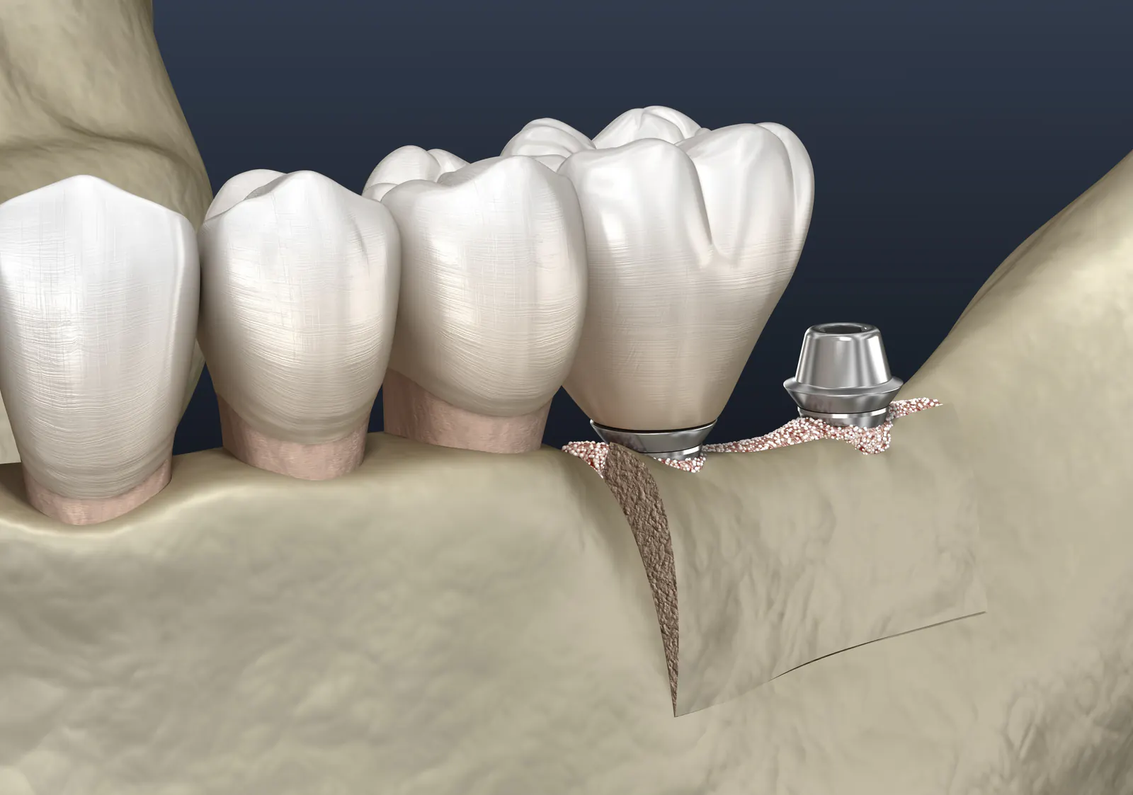 Bone Grafting Procedure