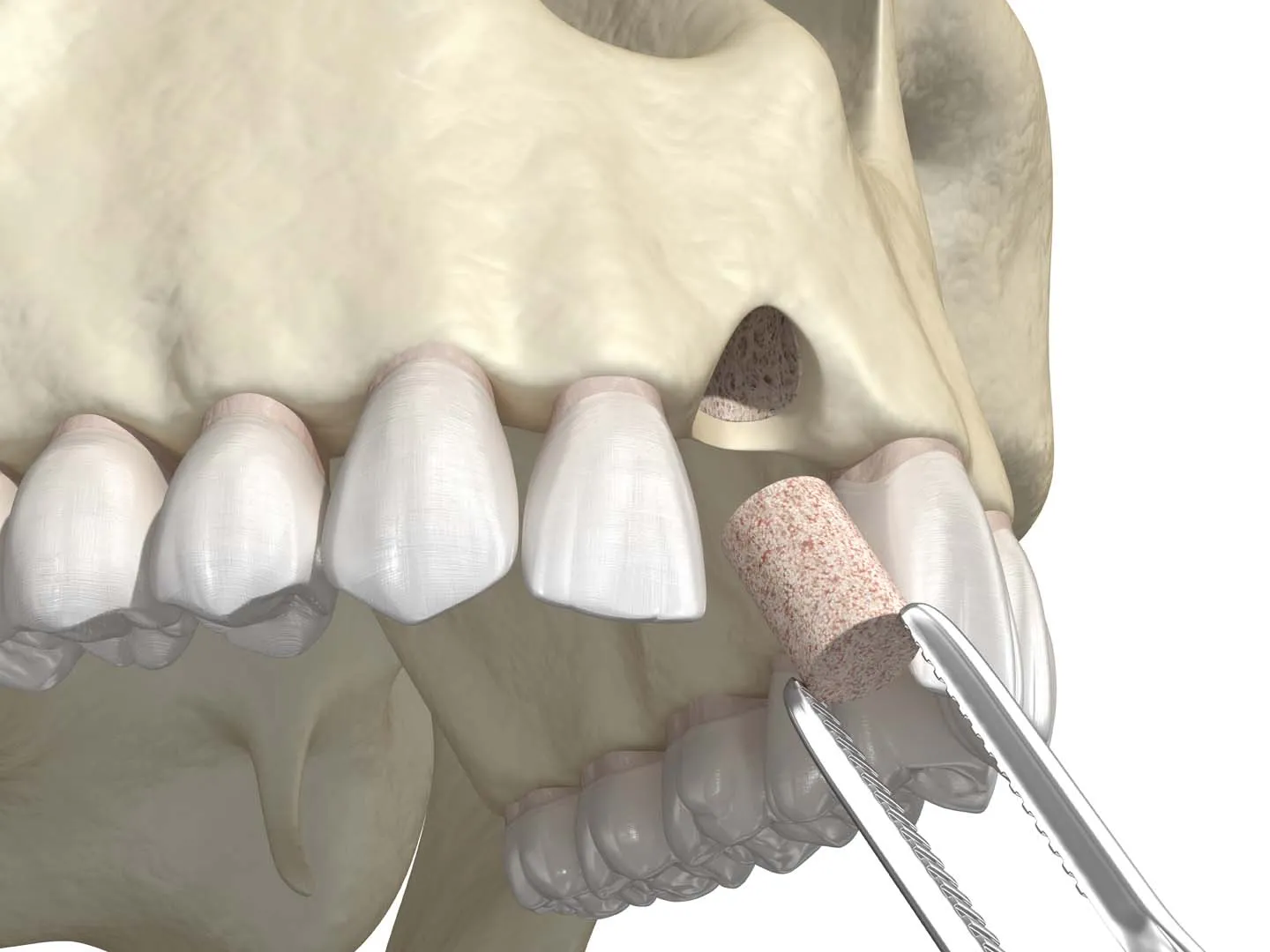 Dental bone grafting procedure