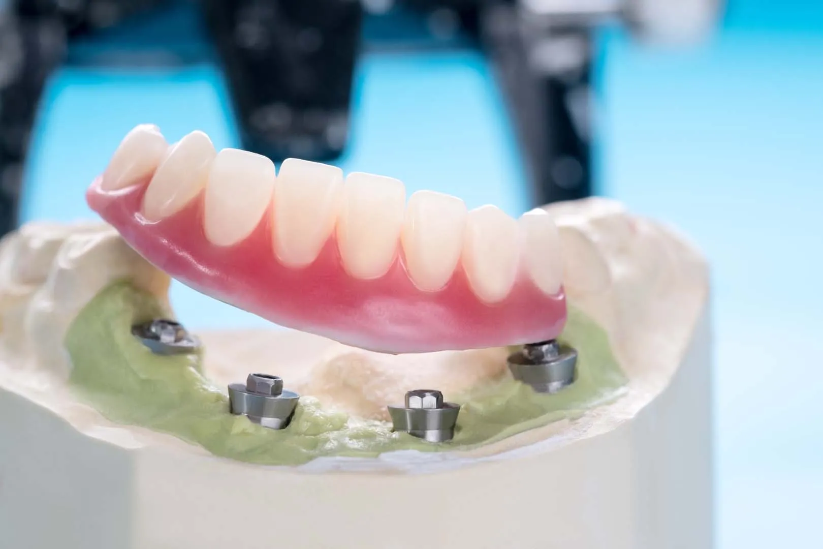 An implant-retained overdenture lifted off the four implant abutments it clicks onto