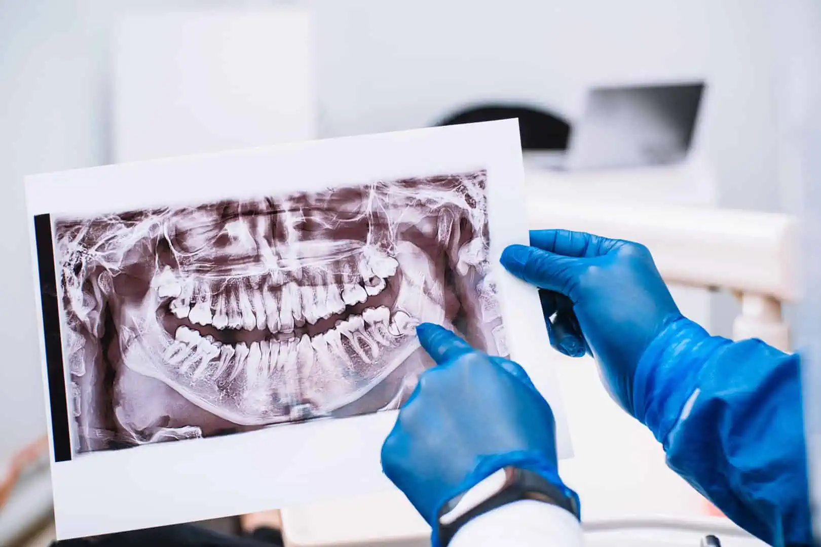 Wisdom teeth removal performed by a board-certified oral surgeon